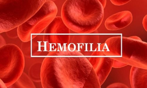 Hemofilia – co wiemy o tej chorobie?